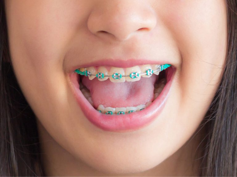 dental braces