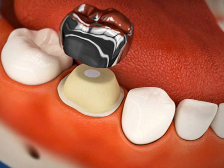 dental-crown