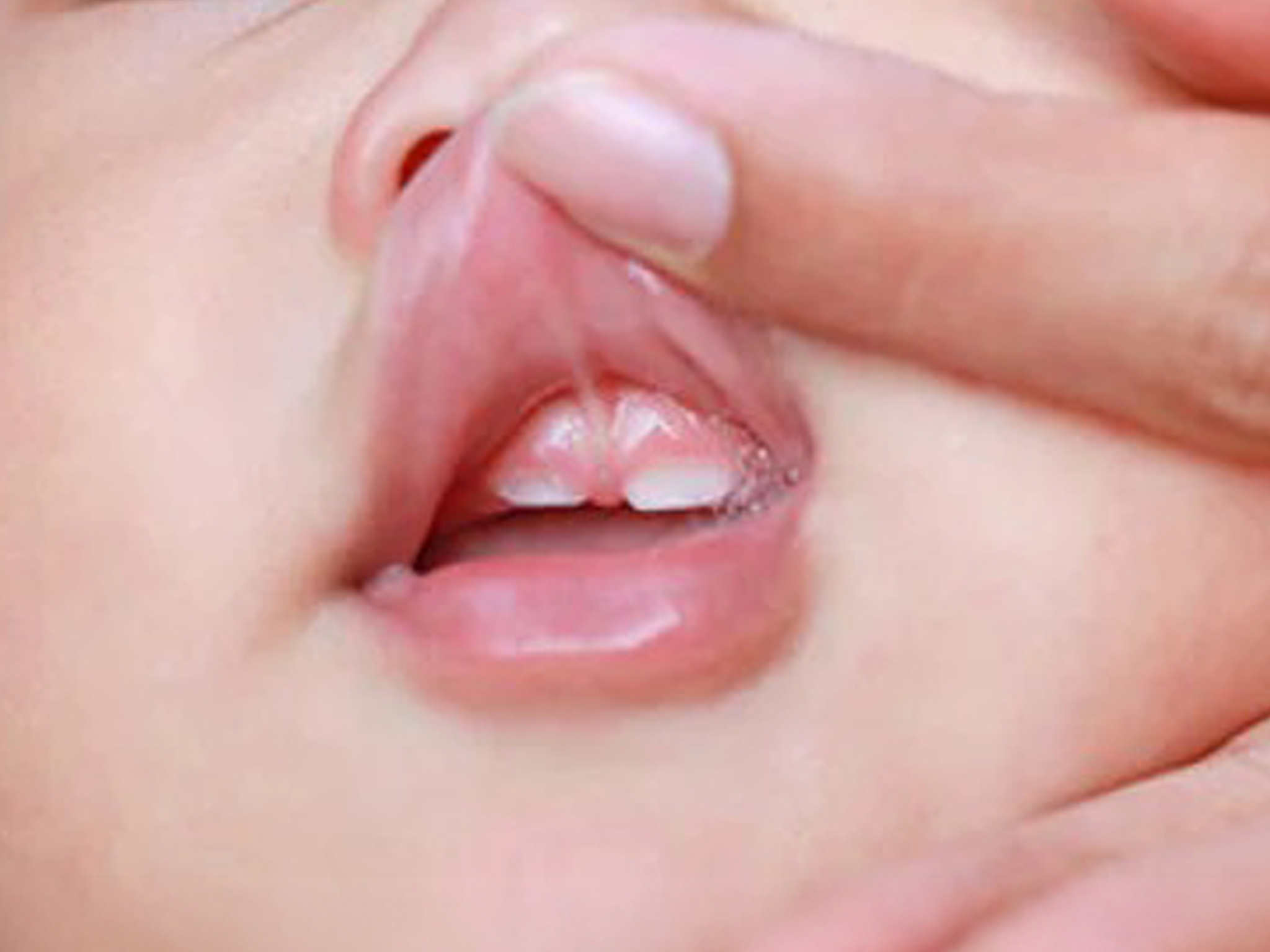 The Role of Pediatric Dentist in Managing Lip Tie in Newborns
