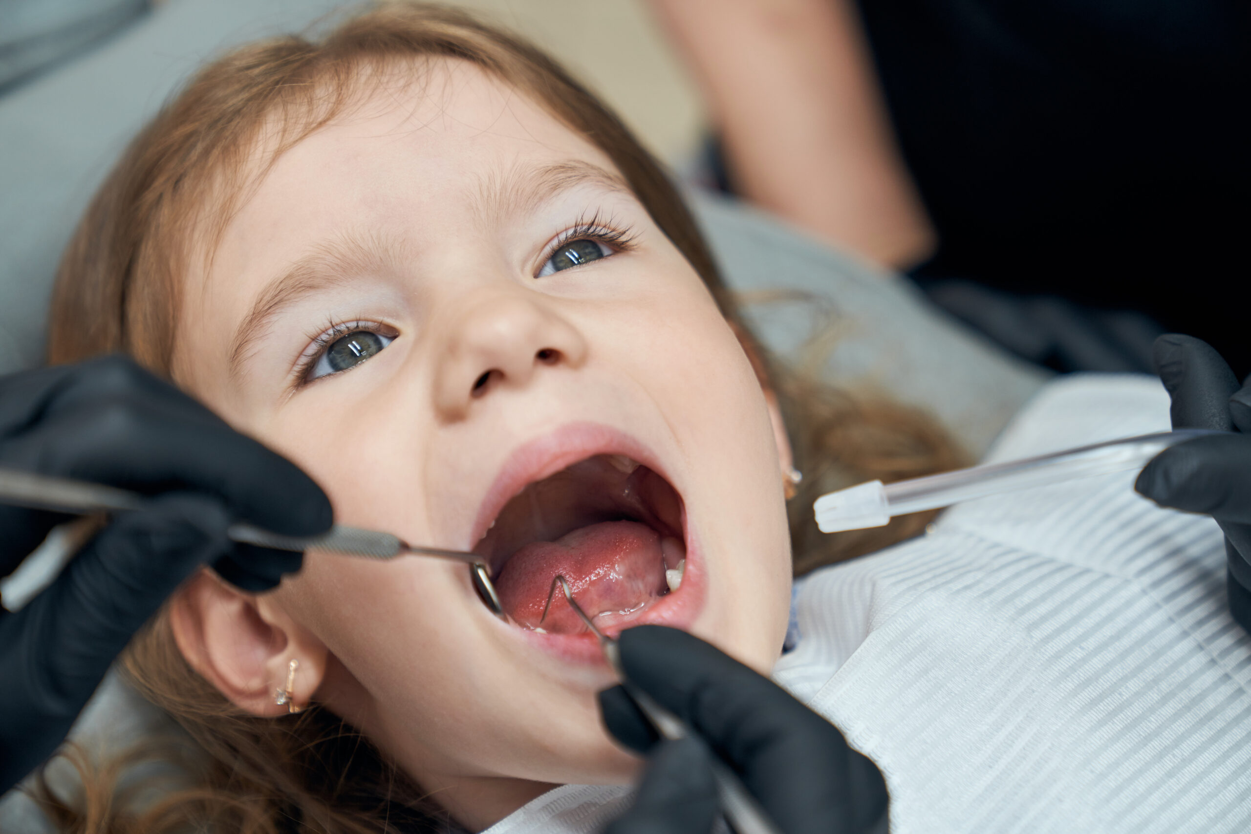 Tooth Extraction in Pediatric Dentistry: When Is It Really Necessary?