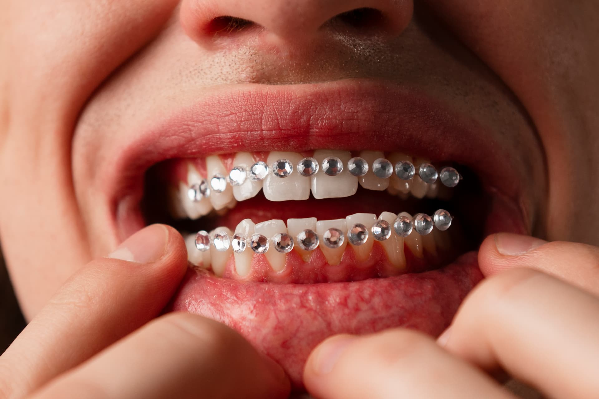 When Do Kids and Adults Need Dental Braces? Signs, Types, and Benefits