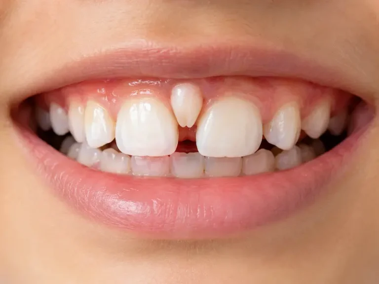 Supernumerary Tooth Removal in Children