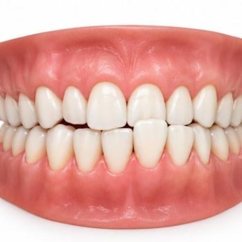 single tooth crossbite