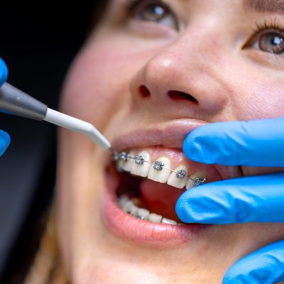 dental Braces